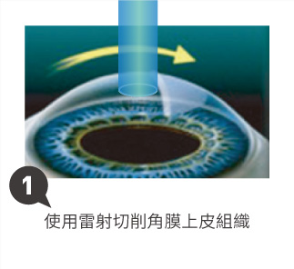 SFAIR TransPRK近視雷射1
