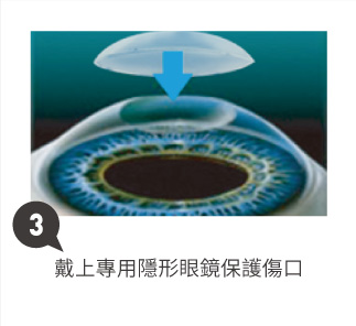SFAIR TransPRK近視雷射3